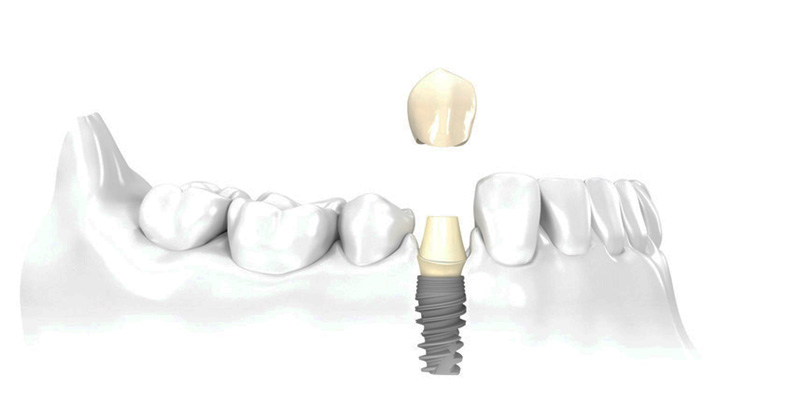 Implant Crown at PERFECT SMILE